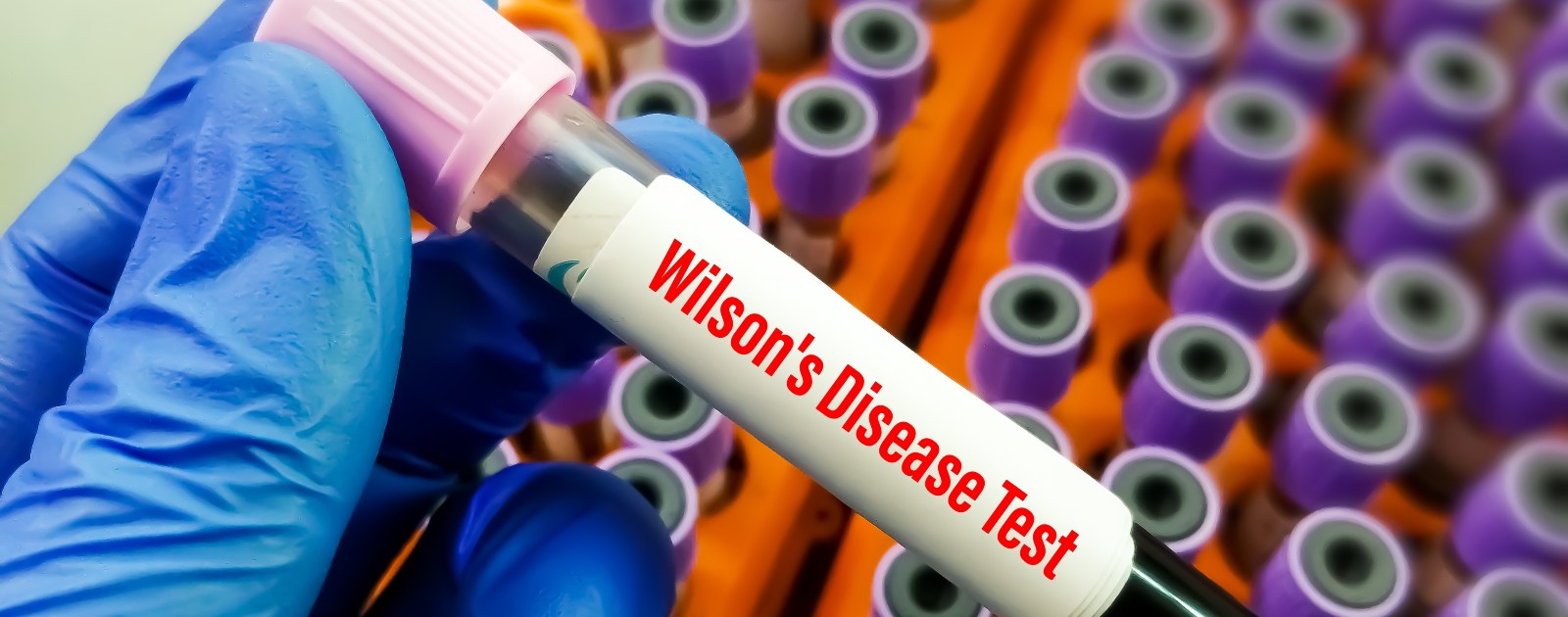 amostra de sangue para testar Doença de Wilson