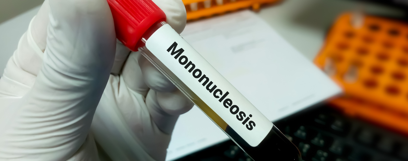 amostra de sangue para testar mononucleose