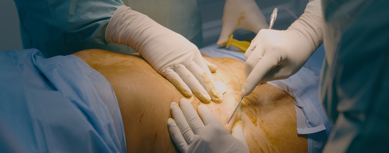 equipa médica a fazer lipoaspiração em paciente