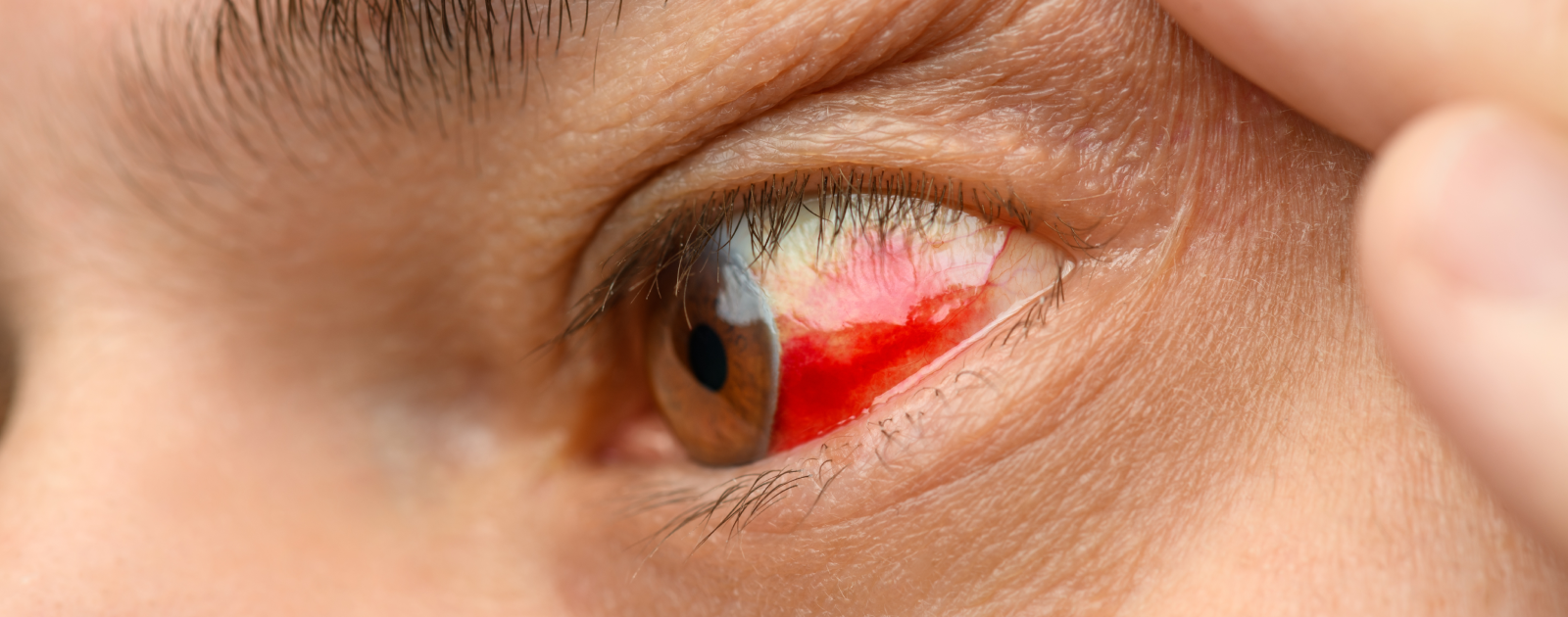 mulher com infeção ocular