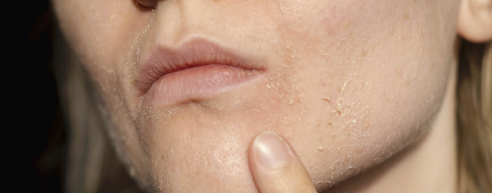mulher com pele a escamar devido a peeling