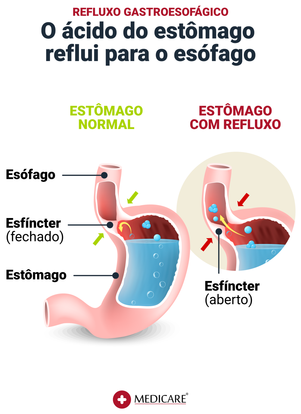 Imagem ilustrativa das diferenças entre o estado de um estomâgo normal e estomâgo com refluxo
