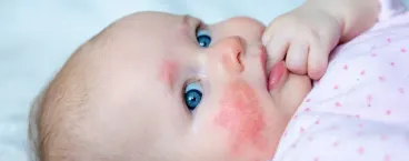bebé com manchas na pele do rosto