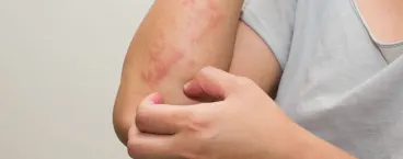 pessoa com comichão no braço