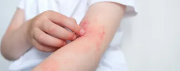 rapariga com vermelhidão no braço causada pela dermatite