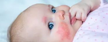 mulher com manchas vermelhas na cara