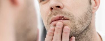homem com herpes labial