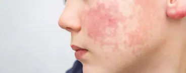 criança com marcas no rosto 