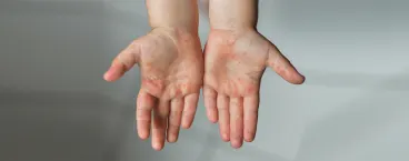 mãos de criança com lesões