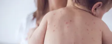 criança com marcas de varicela