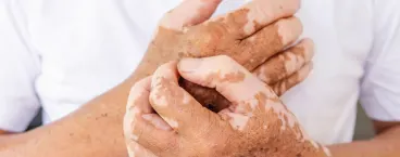 mãos de homem com vitiligo