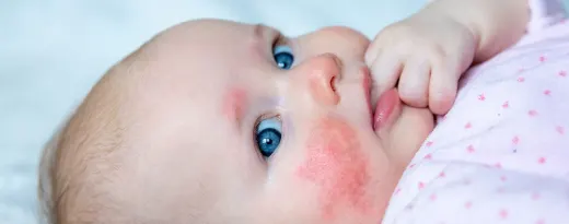 mulher com manchas vermelhas na cara
