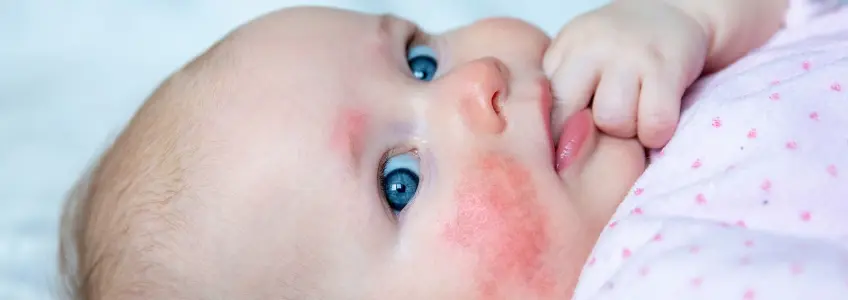 bebé com manchas na pele do rosto