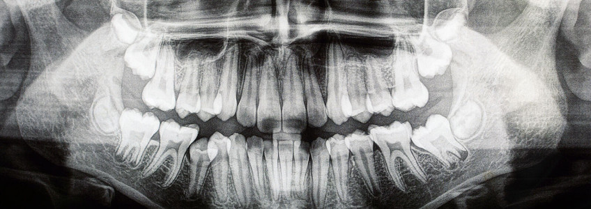raio-x da boca com um dente com problema