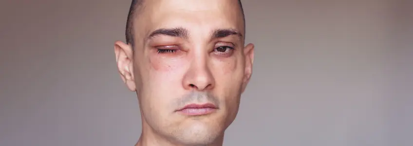 homem com olhos inchados devido a angioedema