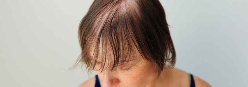mulher com alopecia