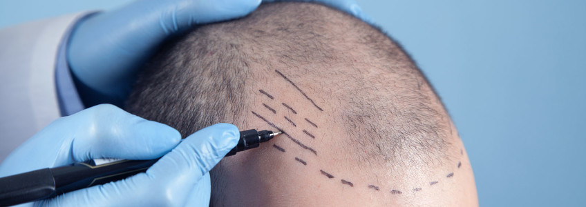 homem a ser preparado para um transplante capilar