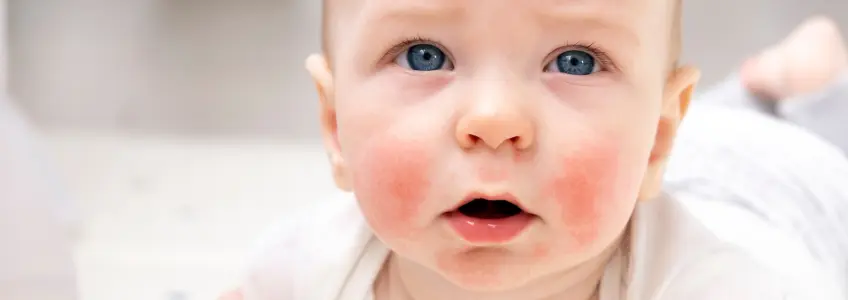 bebé com dermatite atópica