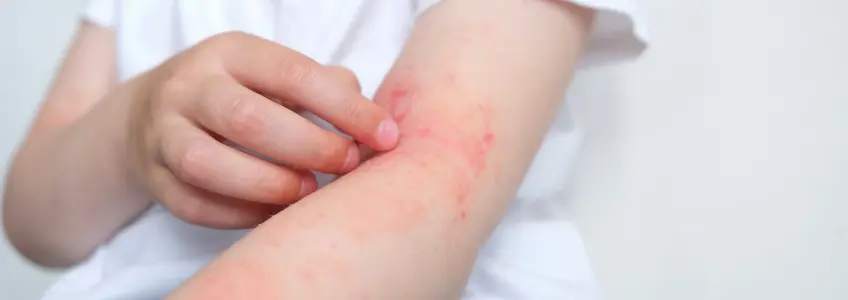 rapariga com vermelhidão no braço causada pela dermatite
