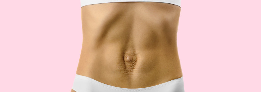 mulher com diastase abdominal