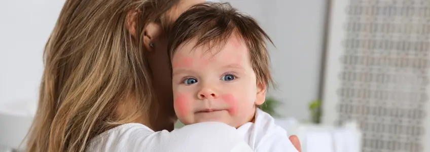 bebé com erupções cutâneas na cara