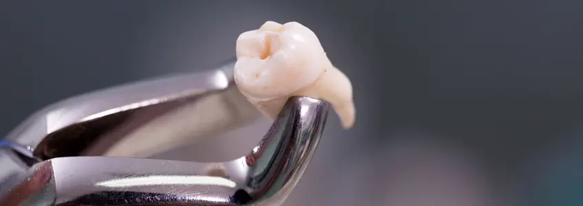 dente acabado de extrair