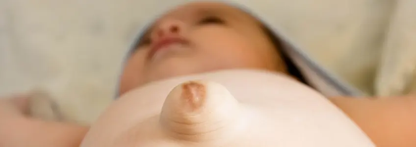 bebé com hérnia umbilical