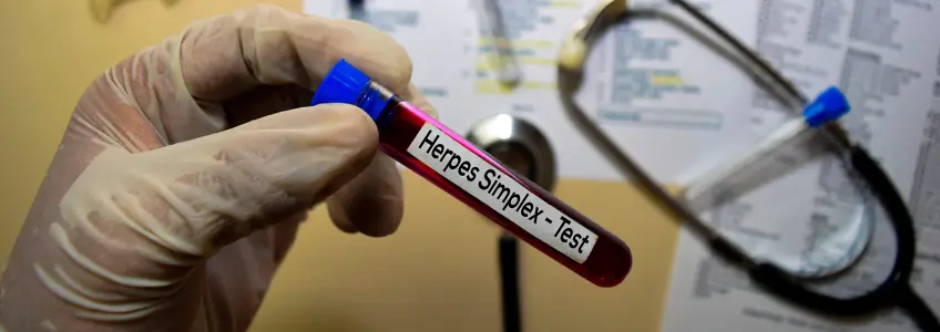 tubo com amostra de sangue para diagnóstico de Herpes simplex