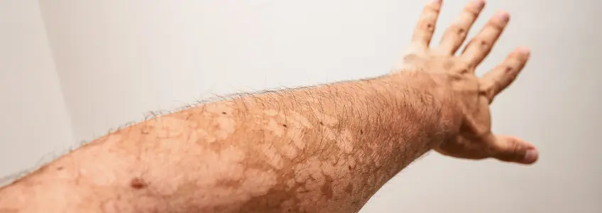 braço de homem com manchas de pitiríase versicolor