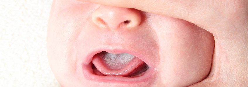 bebé com manchas brancas na língua
