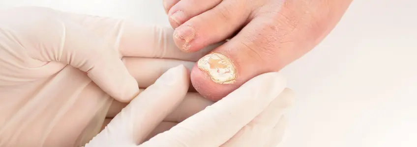dermatologista analisa infeção nas unhas dos pés de paciente