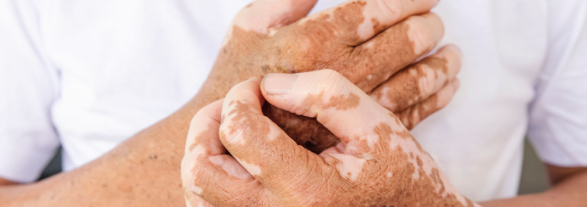 mãos de homem com vitiligo