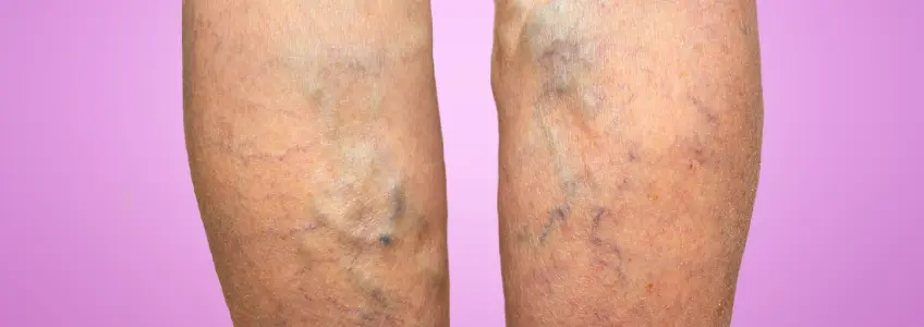 pernas de mulher com varizes
